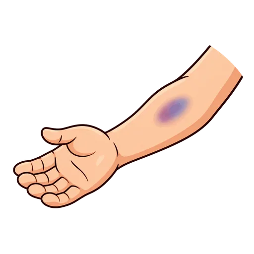 bruise